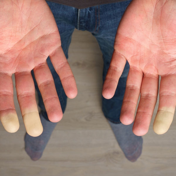 Est-ce que le syndrome de Raynaud est dangereux ?