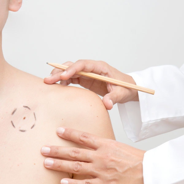 Cancer de la peau : Symptômes, Causes et Examens